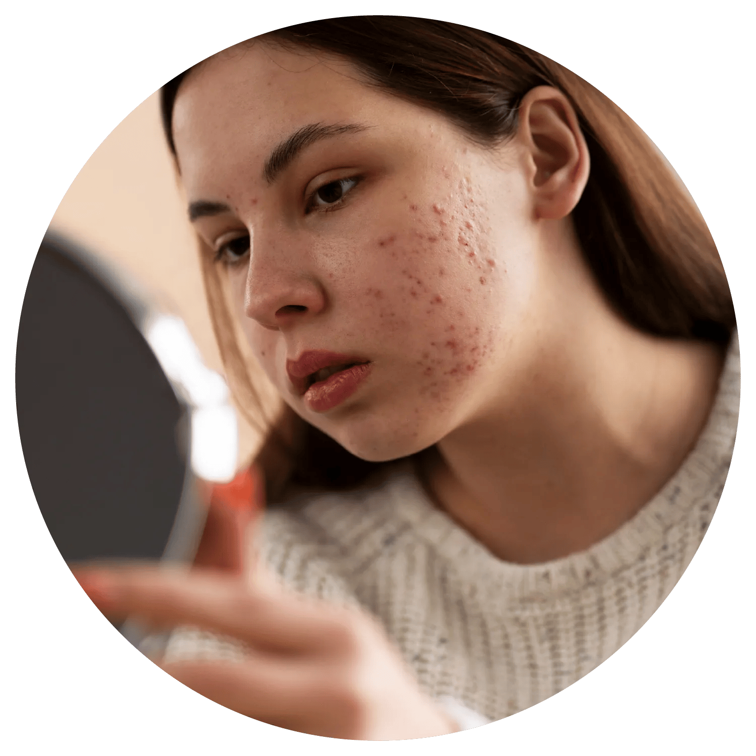 Acne Scarring treatment results at Toronto medical spa - The Chain Reaction of Symptoms
